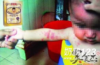 喝了“贝因美”奶粉孩子浑身起疙瘩 喝了“贝因美”奶粉孩子浑身起疙瘩
